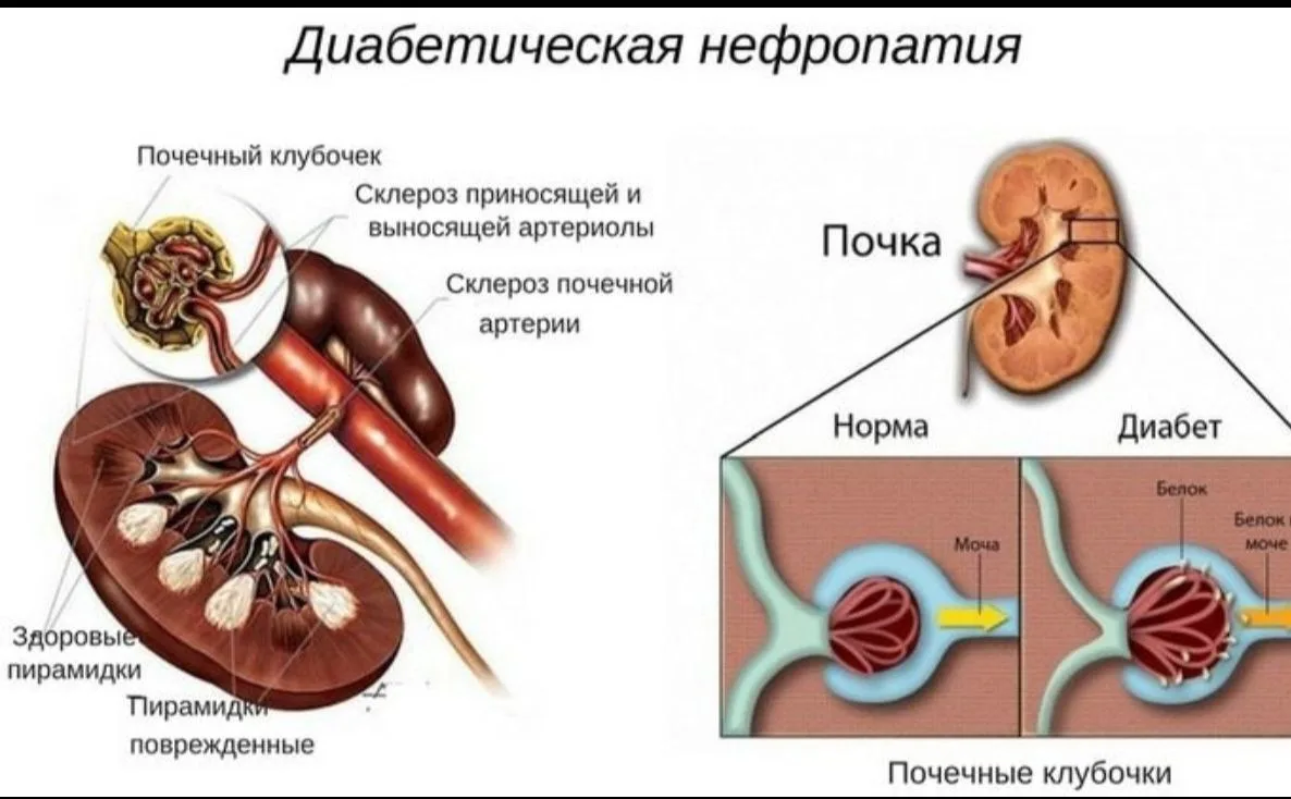Школа диабета