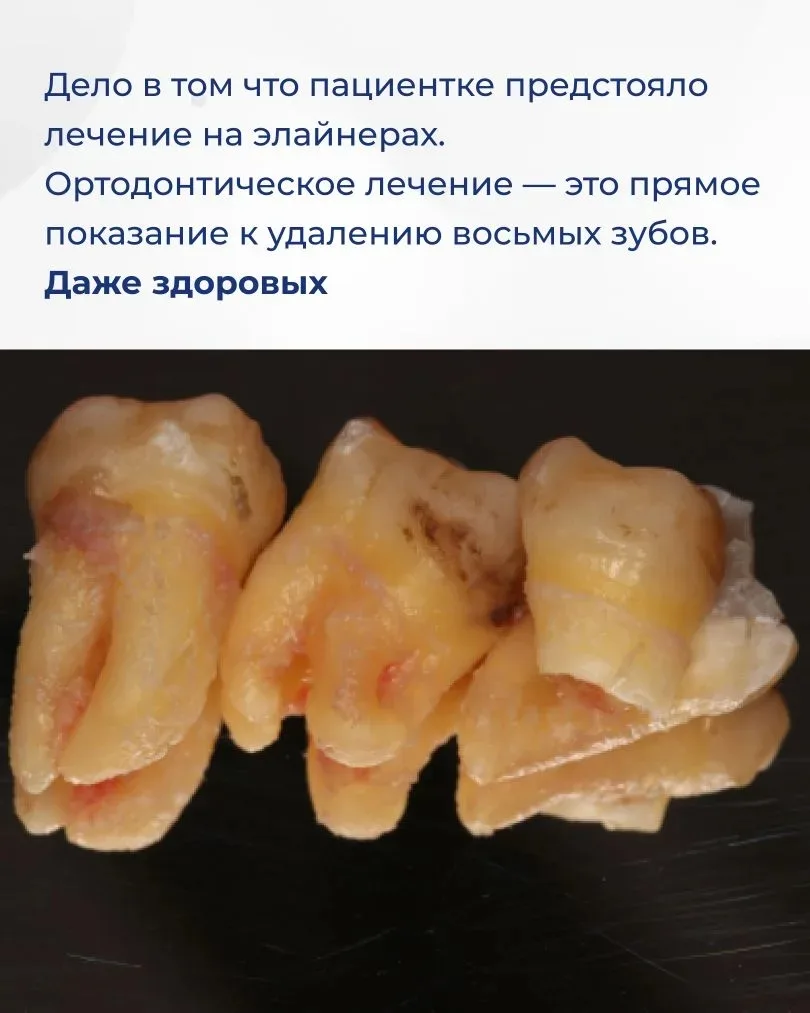 Сразу три зуба удалили пациентке всего за один прием. Это восьмые зубы. Они никак ее не беспокоили и