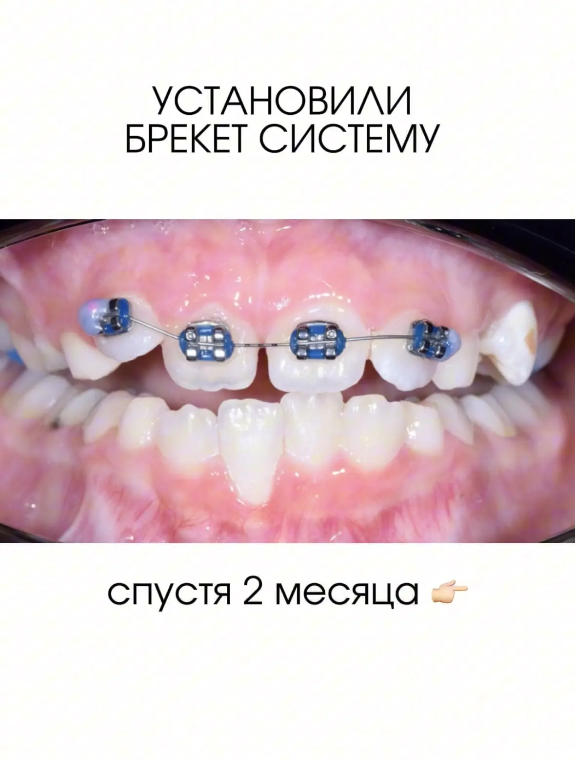 ПОЧЕМУ ВАЖНО ЗАНИМАТЬСЯ ОРТОДОНТИЕЙ С МАЛЫХ ЛЕТ 🦷