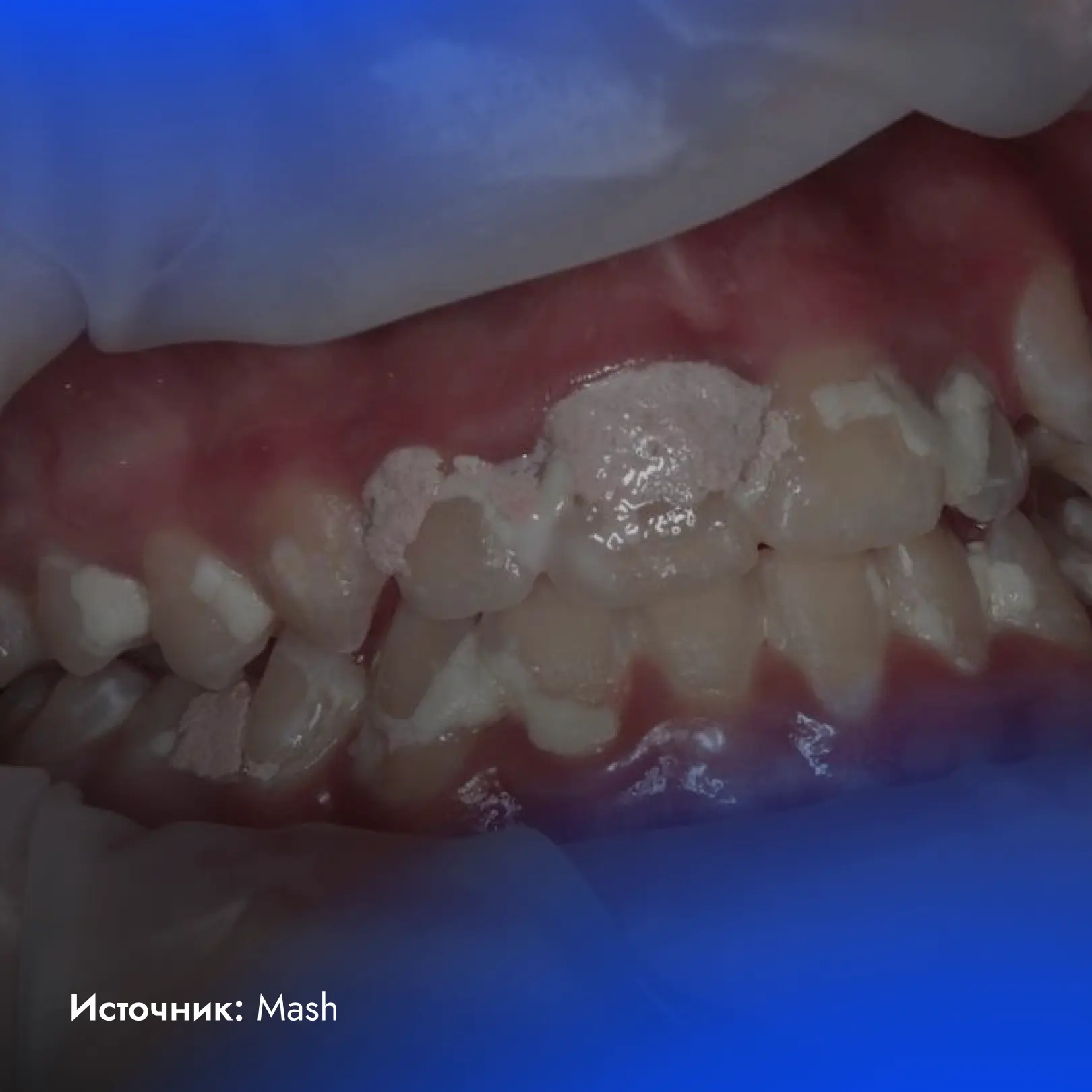 🦷 10-летней девочке испортили зубы в клинике — семье нужно заплатить 2,5 млн руб. за их восстановле
