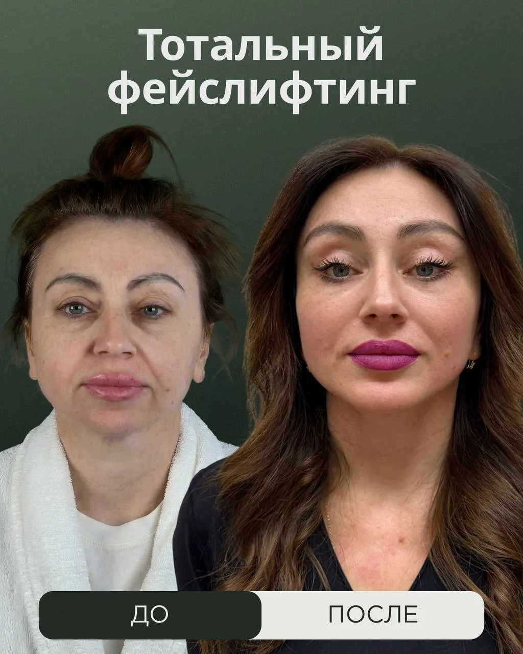 Мы возвращаем молодость на анатомическом уровне. На фото - наша пациентка, результат по...