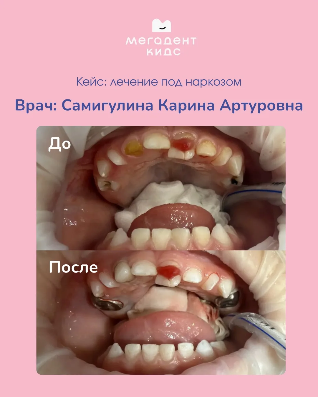 Малышу 1 годик. Упал и сломал зуб (продольный перелом корня и перелом коронки зуба).