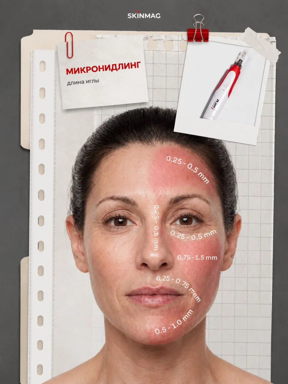 Длина игл при микронидлинге ✅