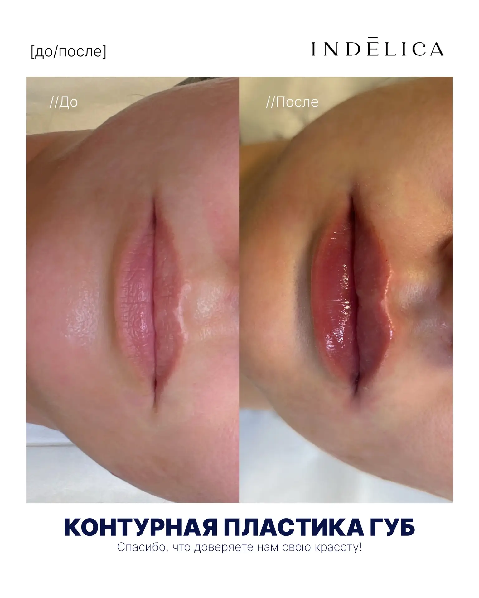 Пациентка хотела добавить объём и подчеркнуть контур, но боялась неестественного резуль...