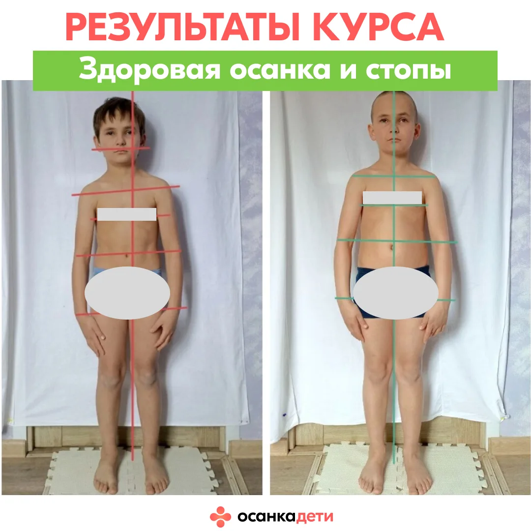 Его «до» — это стельки, «рукопашка» и ….  сутулость. После — смотрите в карусели результаты Савелия 