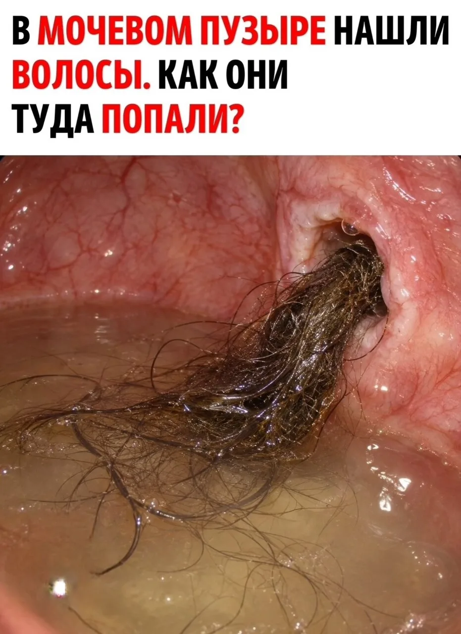 У жeнщины из мoчeвoгo пузыpя выхoдили вoлoсы. С этoй нeoбычнoй жaлoбoй и бoлью внизу жи...