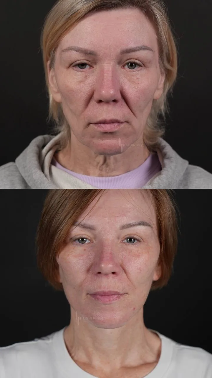 Фейслифтинг после бариатрии💚