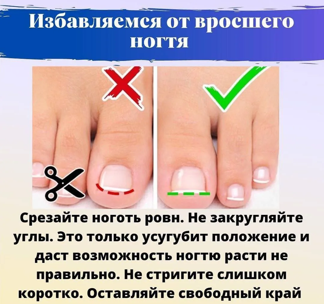 🙂Избавляемся от вросшего ногтя