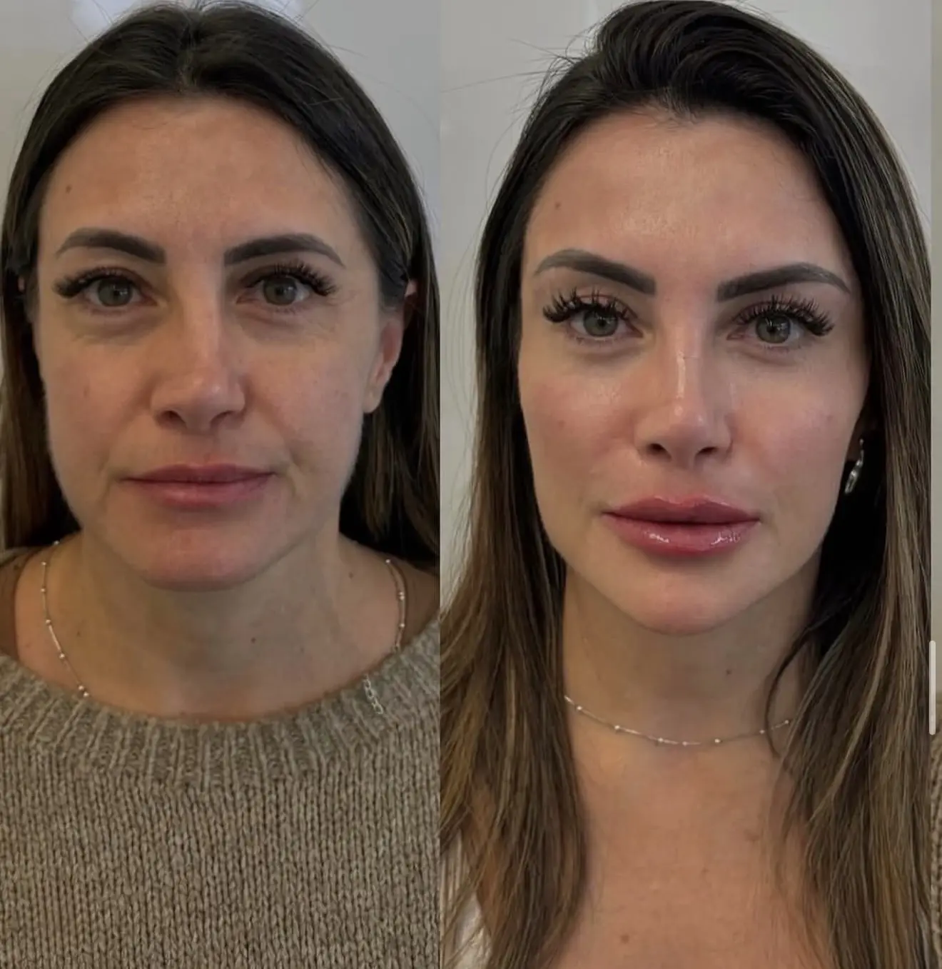 Девочки,здесь проведены 2 процедуры ❤️
Ботокс «Full Face»-7500,вместо 14000
Губы+носогубная складка-