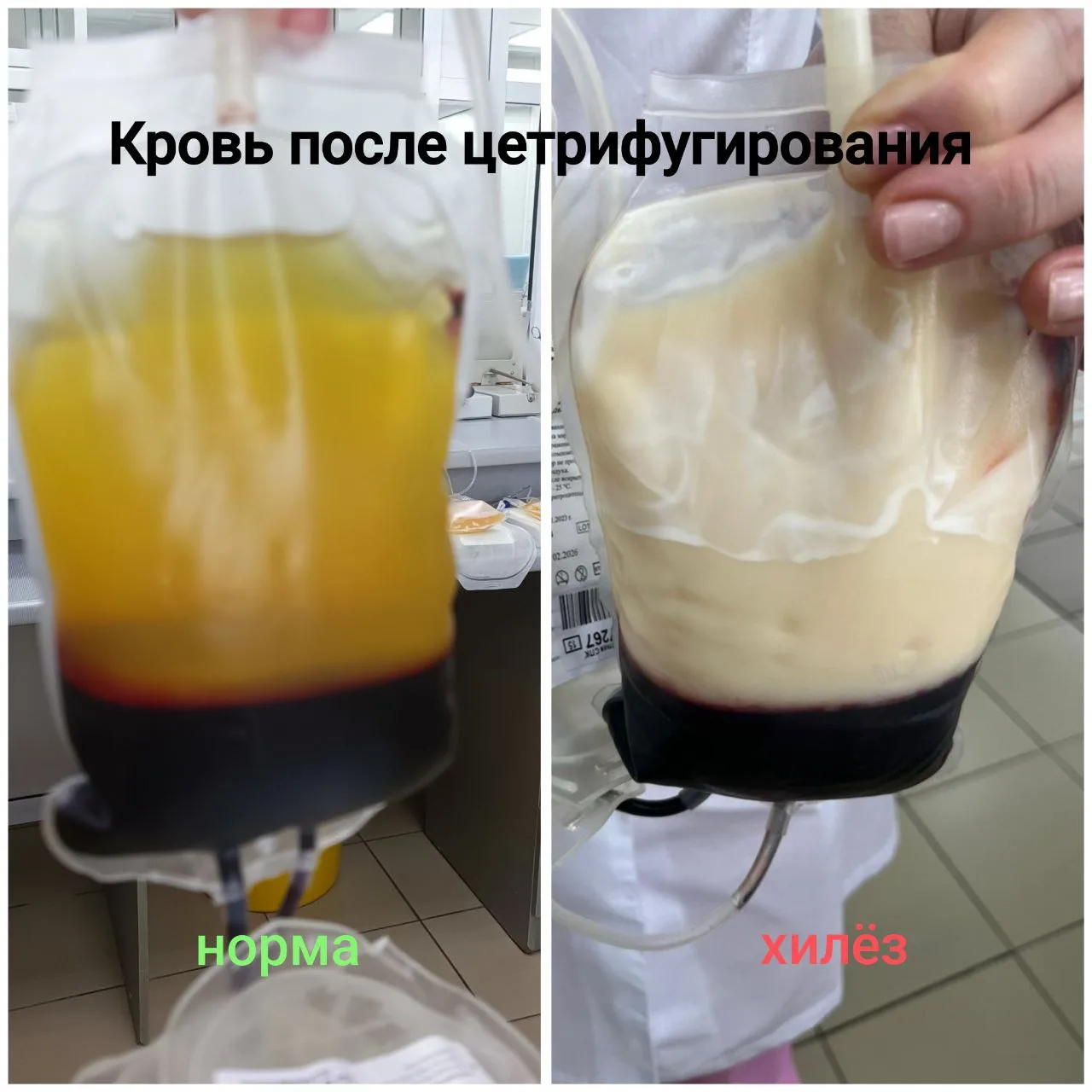 Уважаемые доноры! Статистика хилёза, а это значит БРАКА  за май  - 112 ПАКЕТОВ  ‼️- были утилизирова