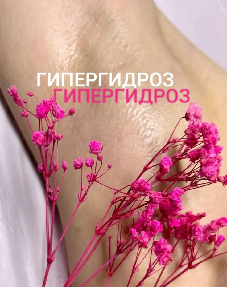 ❗Лечение гипергидроза