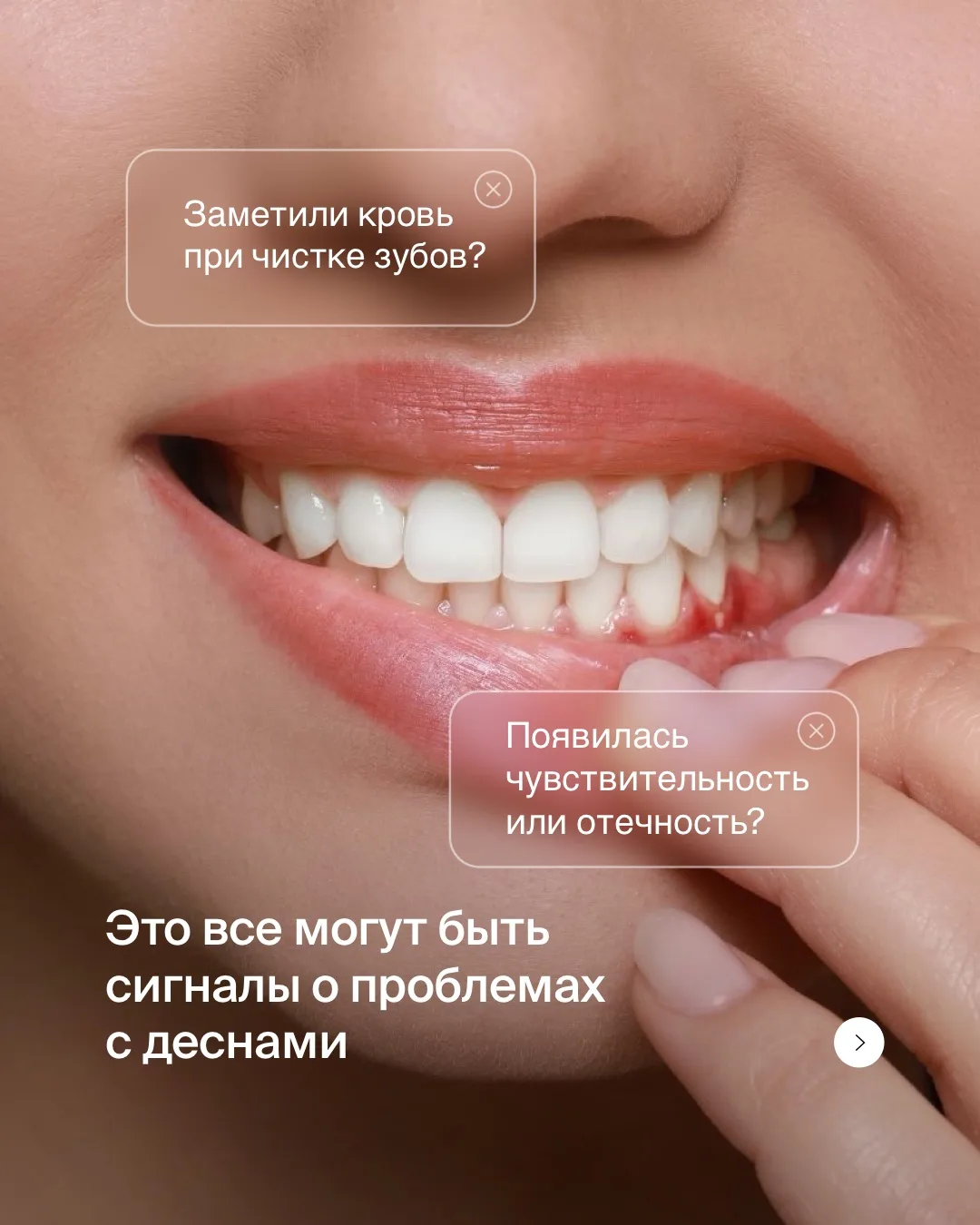 📌 КАК СОХРАНИТЬ ДЕСНУ ЗДОРОВОЙ
