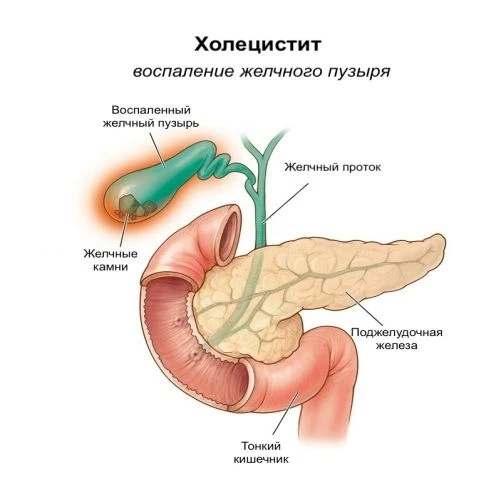 ⚠️ Калькулёзный холецистит: какие признаки должны вас насторожить?