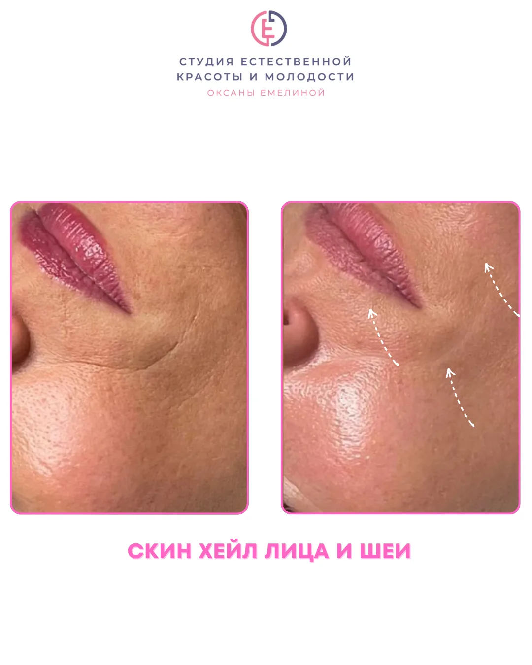 Почему скин хейл сейчас выигрывает у многих процедур?
✅Она сочетает в себе несколько одновременно:

