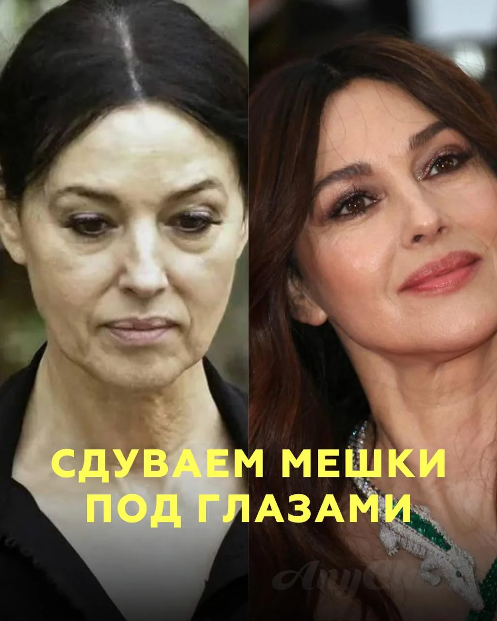 Избавляемся от мешком под глазами без операции