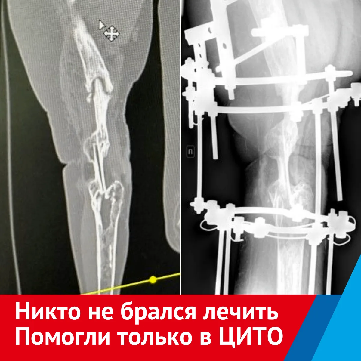 💔  «Каждый шаг — боль». Как в НМИЦ Приорова спасли ногу пациентки 🏥