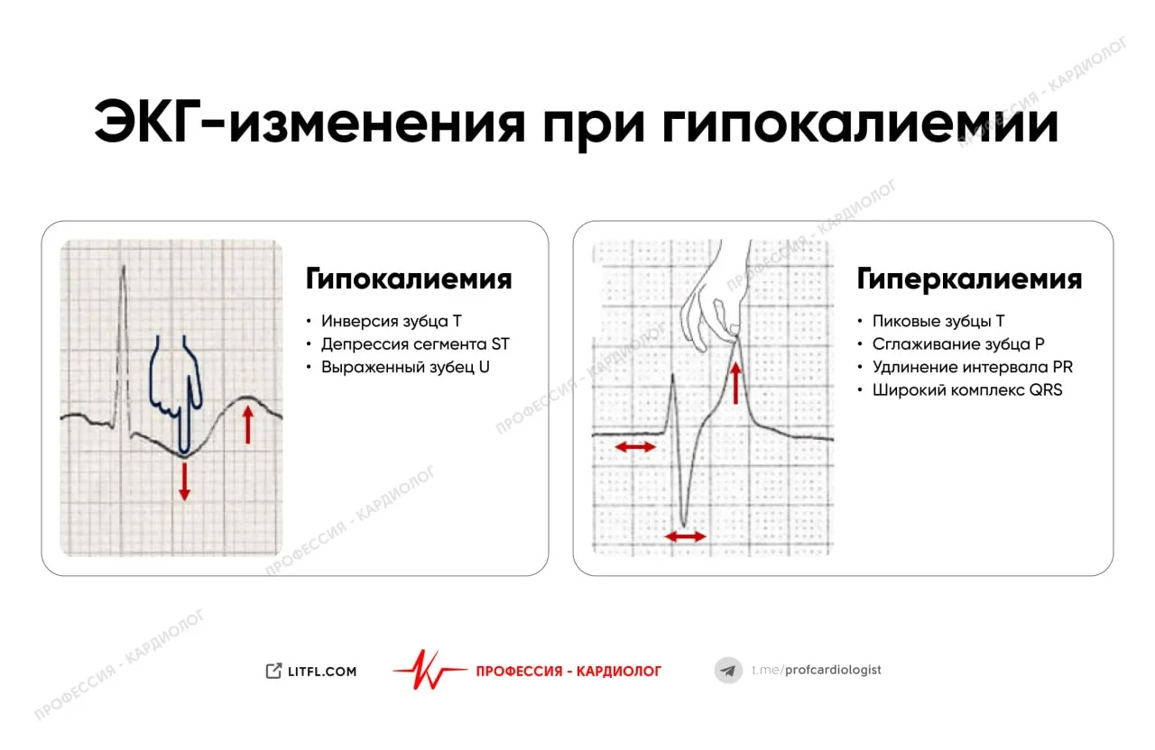 ЭКГ при изменениях уровня калия

Гипокалиемия создаёт иллюзию «сдвига» зубца Т вниз, что приводит к 