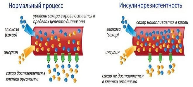 К чему ведет инсулинорезистентность:
- поражение эндотелия сосудов (повышение давления и путь к инфа