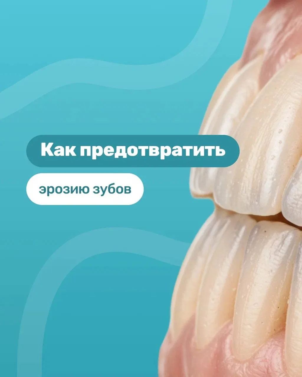🦷 Эрозия зубов: почему возникает и как предотвратить?
