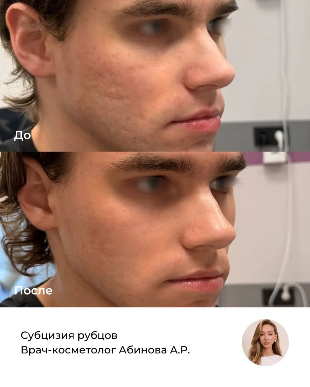 Результат субцизии рубцов с применением Сферогеля от врача-косметолога Азизы Рашидовны ...