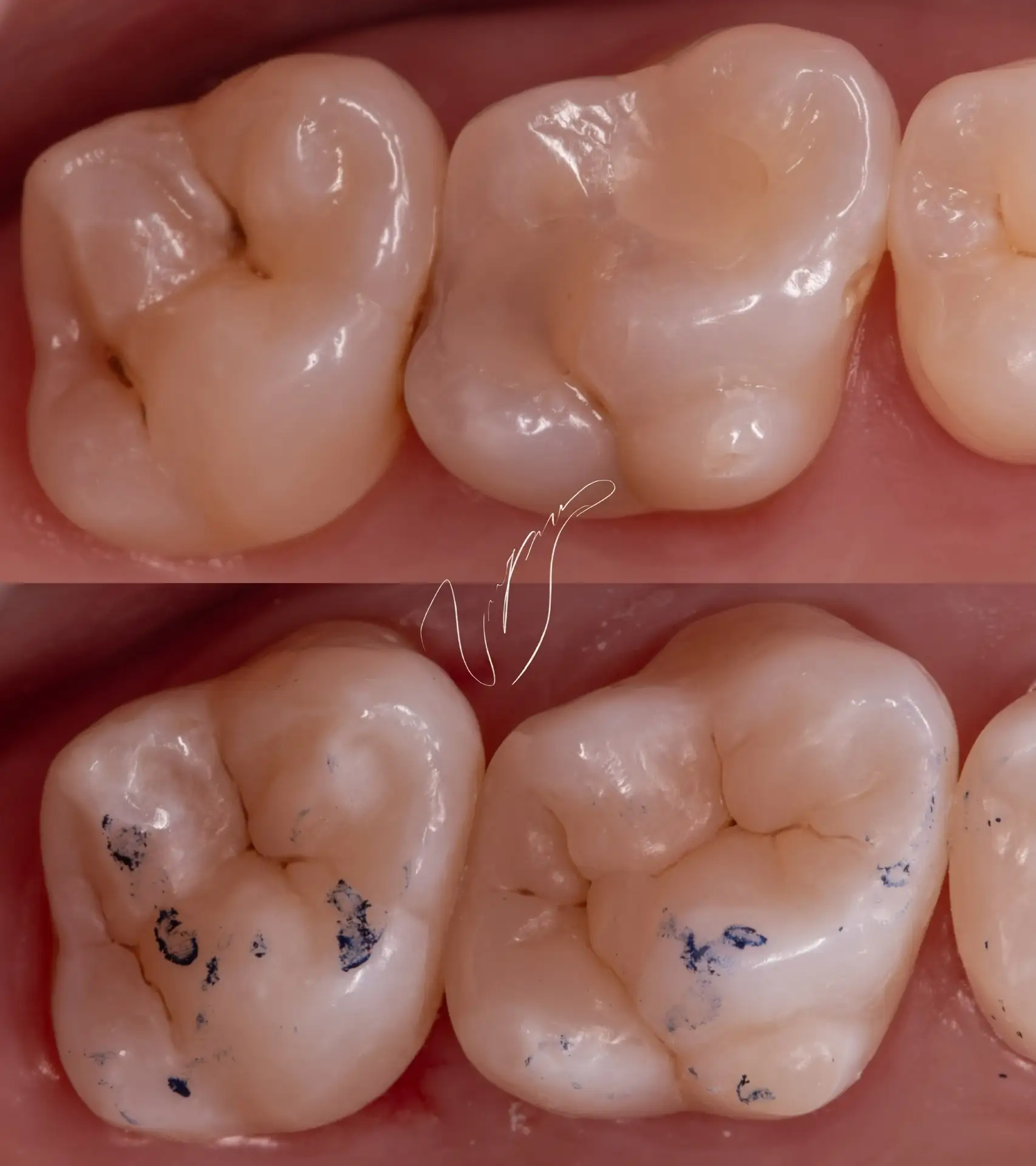 DIRECT POSTERIOR