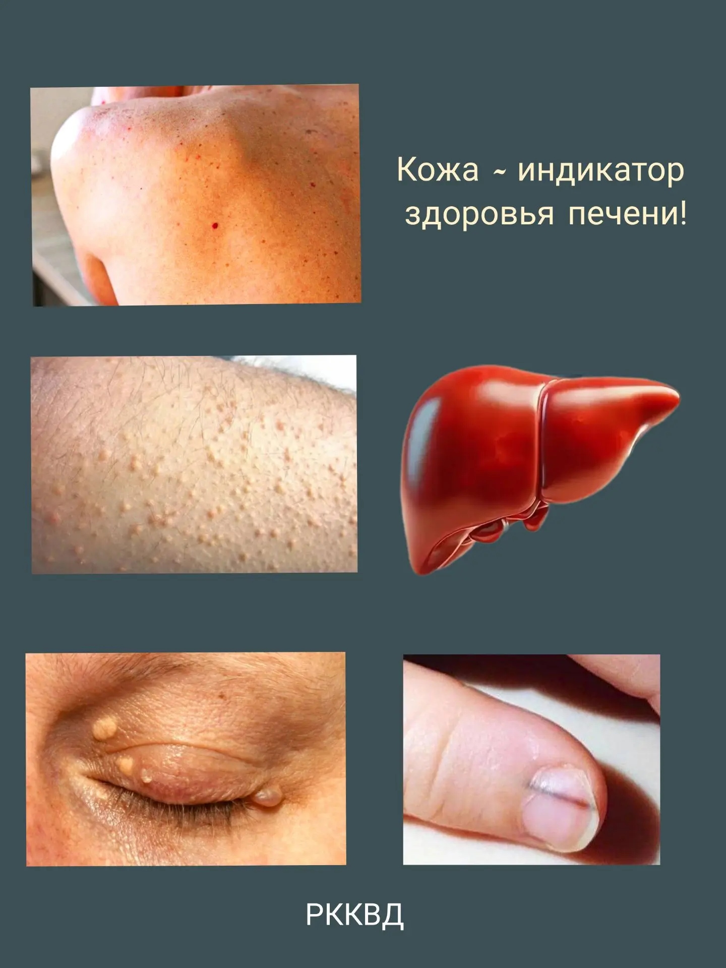 Кожа знает больше, чем кажется, порой она первой сообщает о проблемах с печенью.

Подробная информац