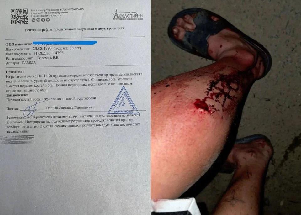 «Розочка» вместо закона: в Находке двое мужчин стали жертвами жестокой расправы