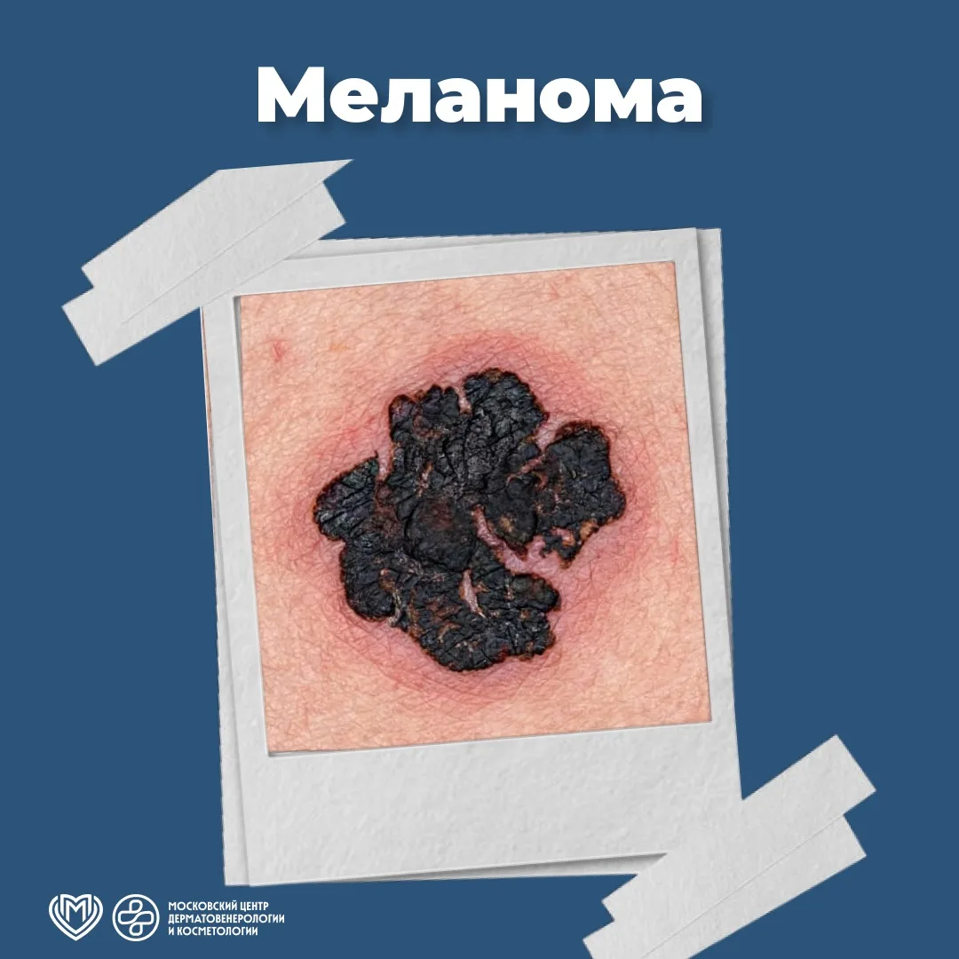 🔘 Меланома кожи – злокачественная опухоль, исходящая из меланоцитов (пигментных клеток...