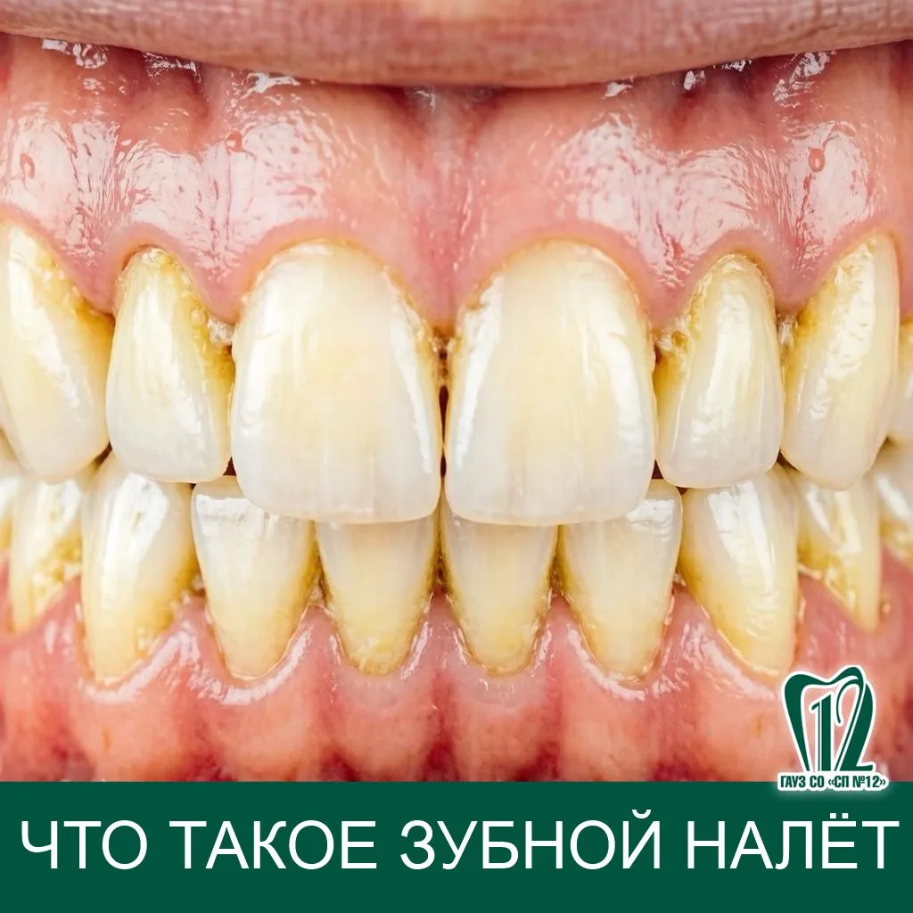 Что такое зубной налёт ?