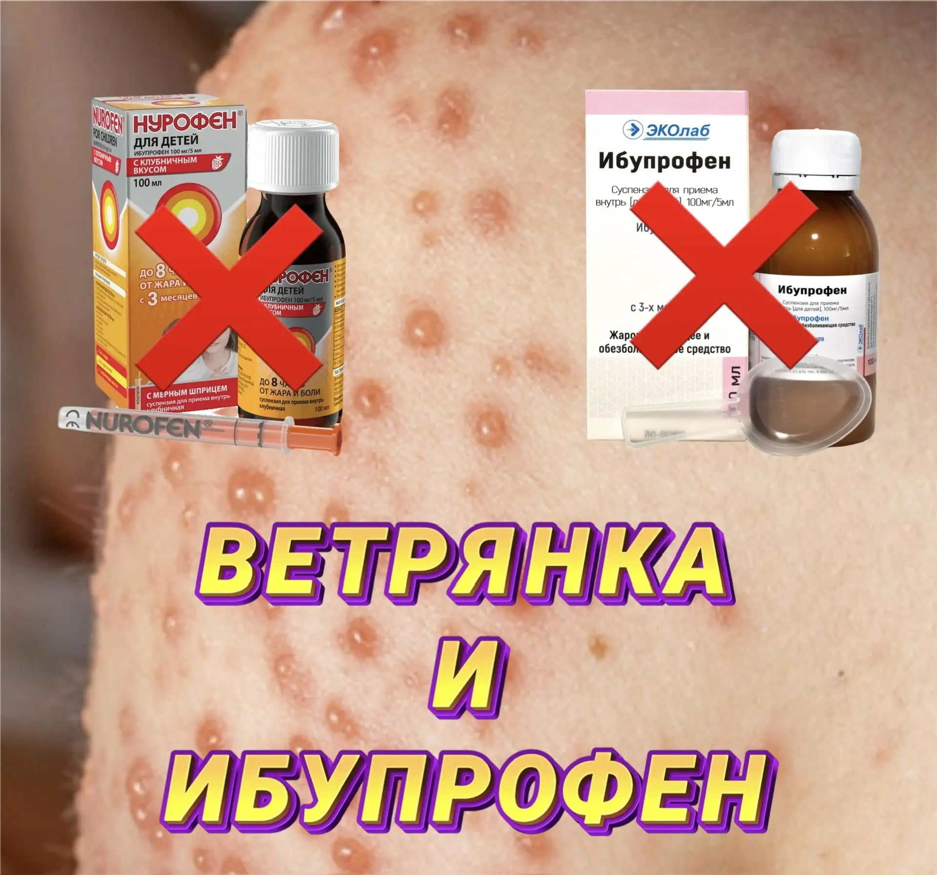 Хочу напомнить о том, что при ветряной оспе (ветрянке) не рекомендован приём Нурофена (ибупрофена) в