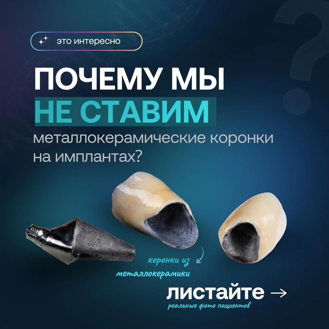 ❌Металлокерамика: почему мы говорим ей твердое «НЕТ» при протезировании на имплантах? Ч...