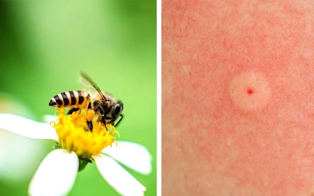 Остерегайтесь укусов насекомых!

 🐝Лето - это долгожданные отпуска, яркие путешествия и счастливые 
