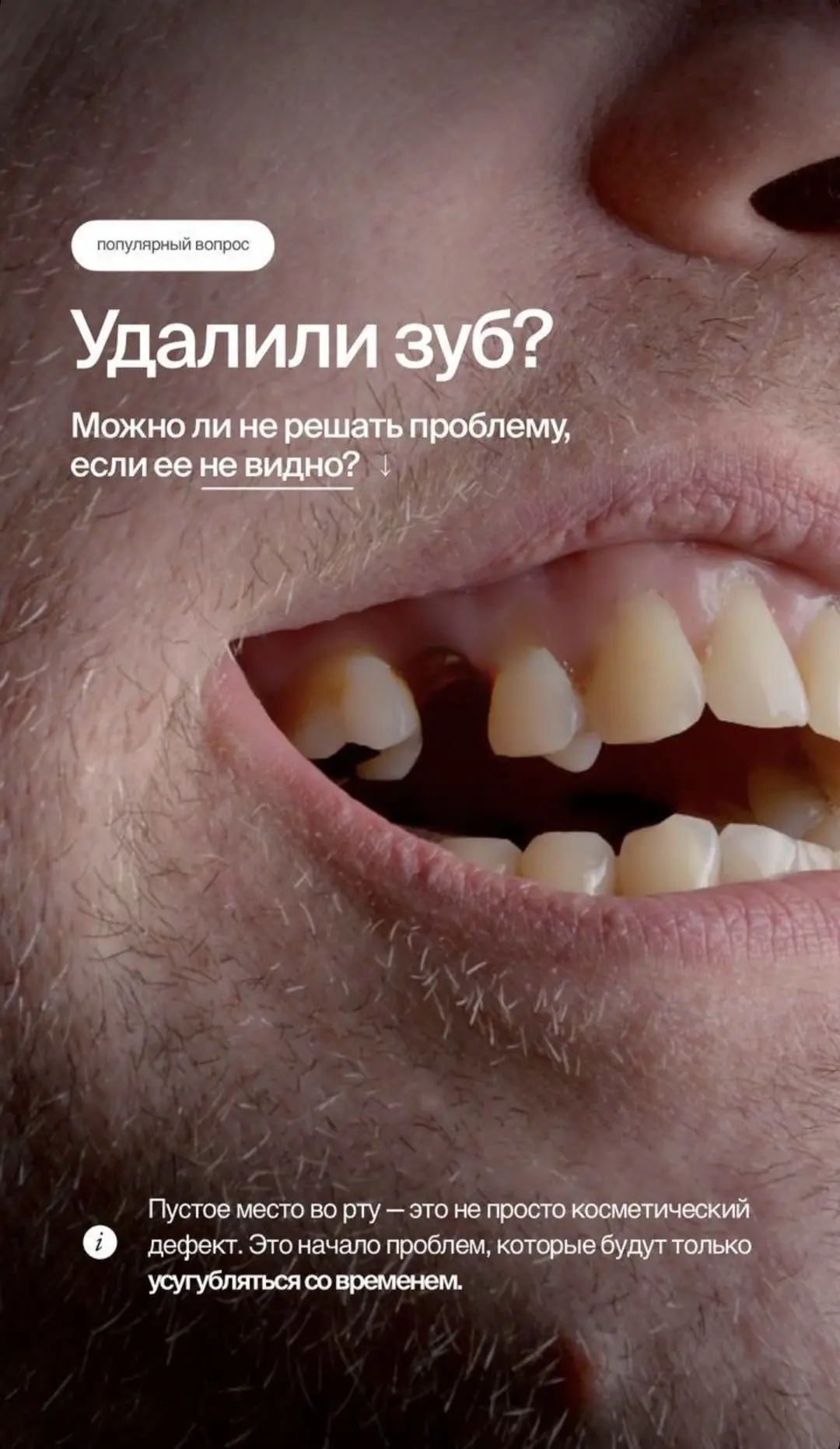 🦷УДАЛЕНИЕ ЗУБА🦷