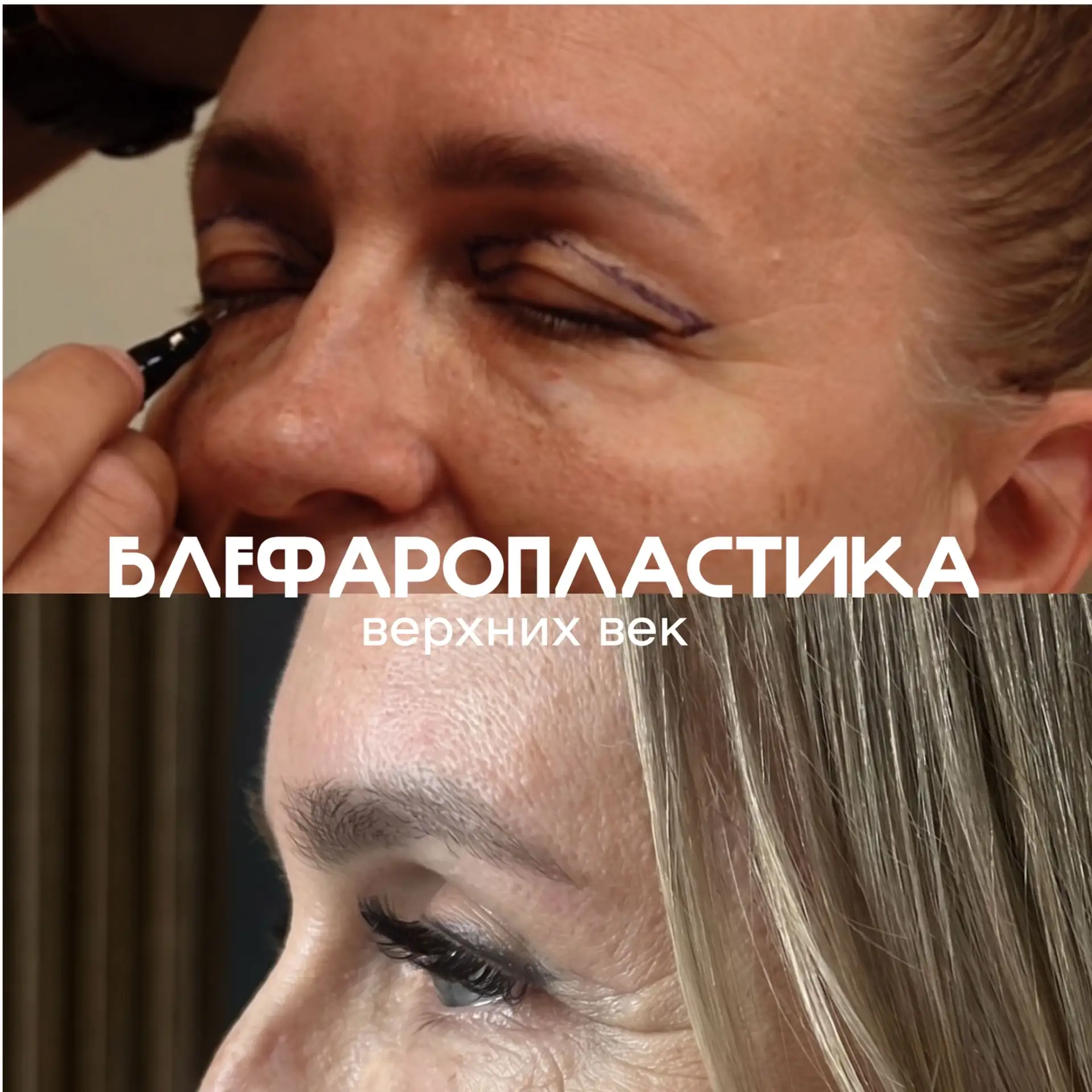 Операция выполнена пластическим хирургом Назлиевым Данаилом Красимировичем, операция была проведена 