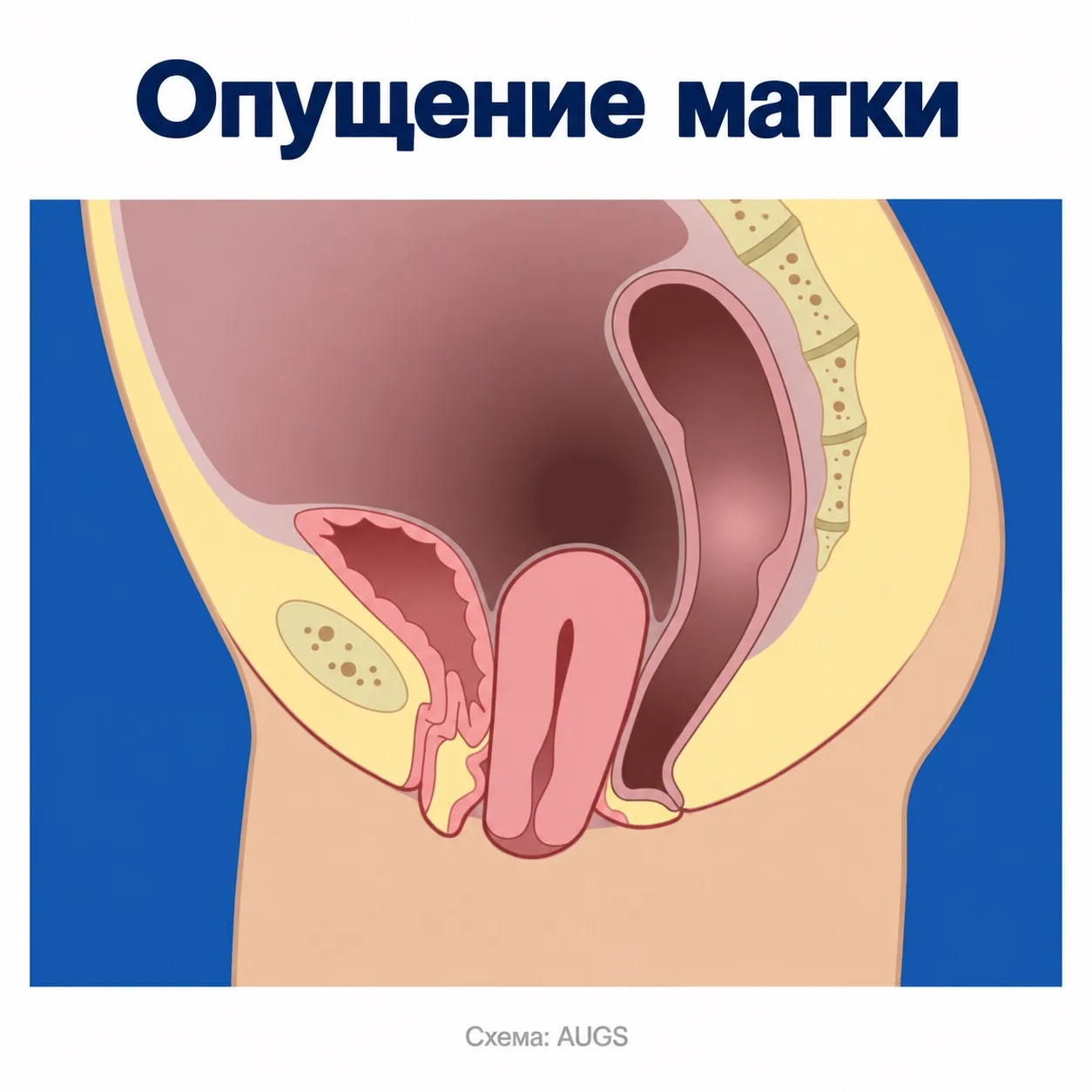 Хочу поговорить про удаление матки 📢