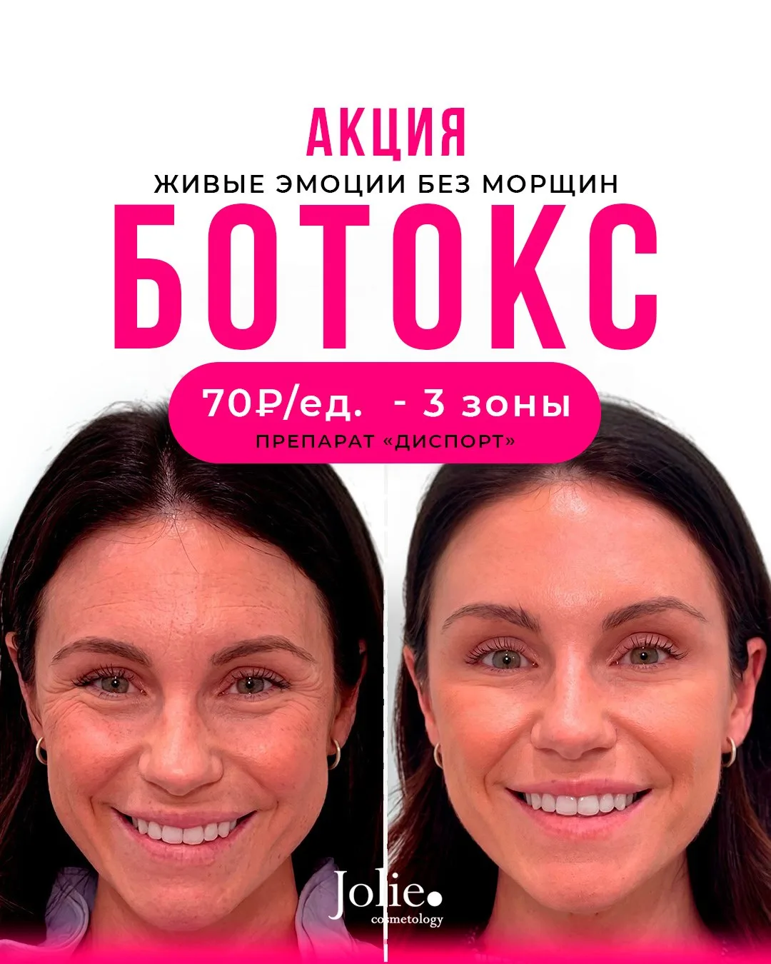 Почему важно делать ботокс летом?😎

☀️ Солнце, прищур и активная мимика усиливают напряжение в зоне