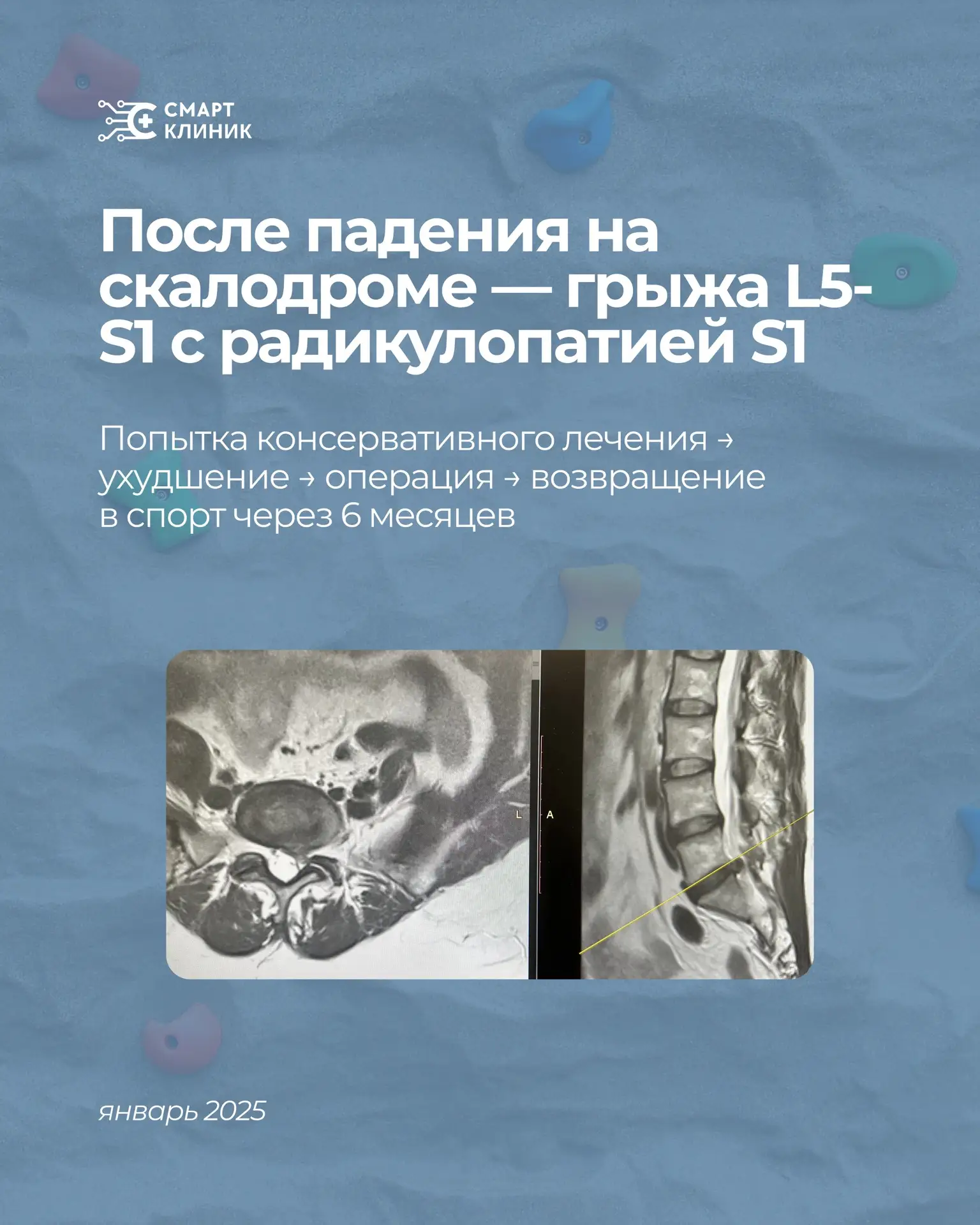 Микродискэктомия — это не финал лечения. И, пожалуй, один из самых частых провалов посл...
