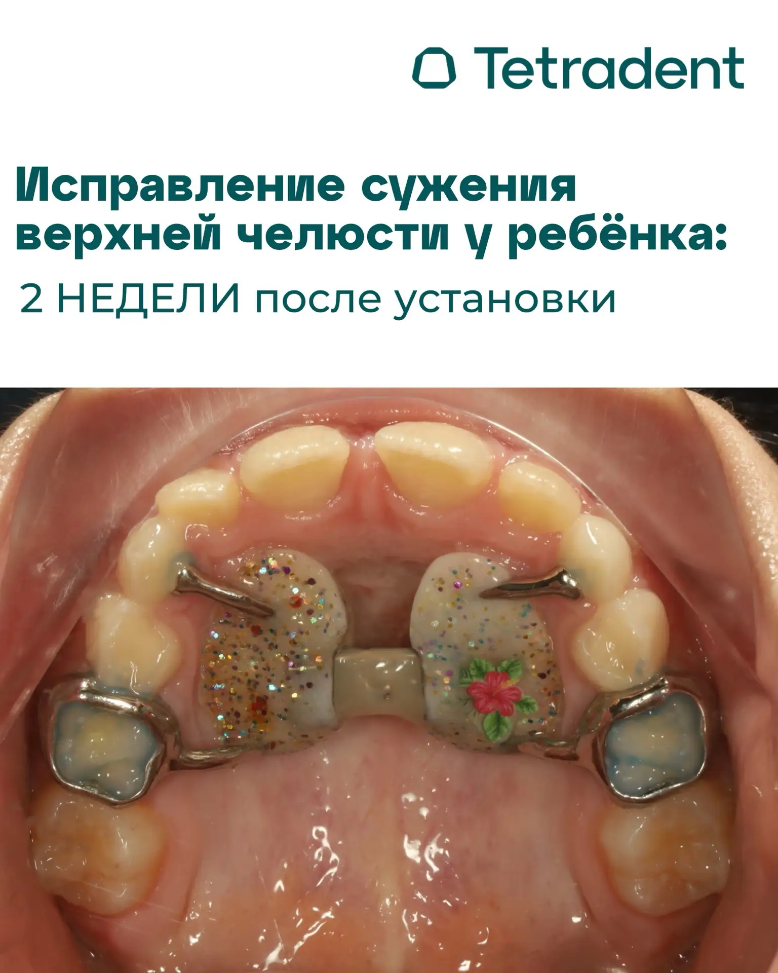 2 недели с начала расширения верхней челюсти: первые результаты уже заметны ✨🦷

Продолжаем делиться