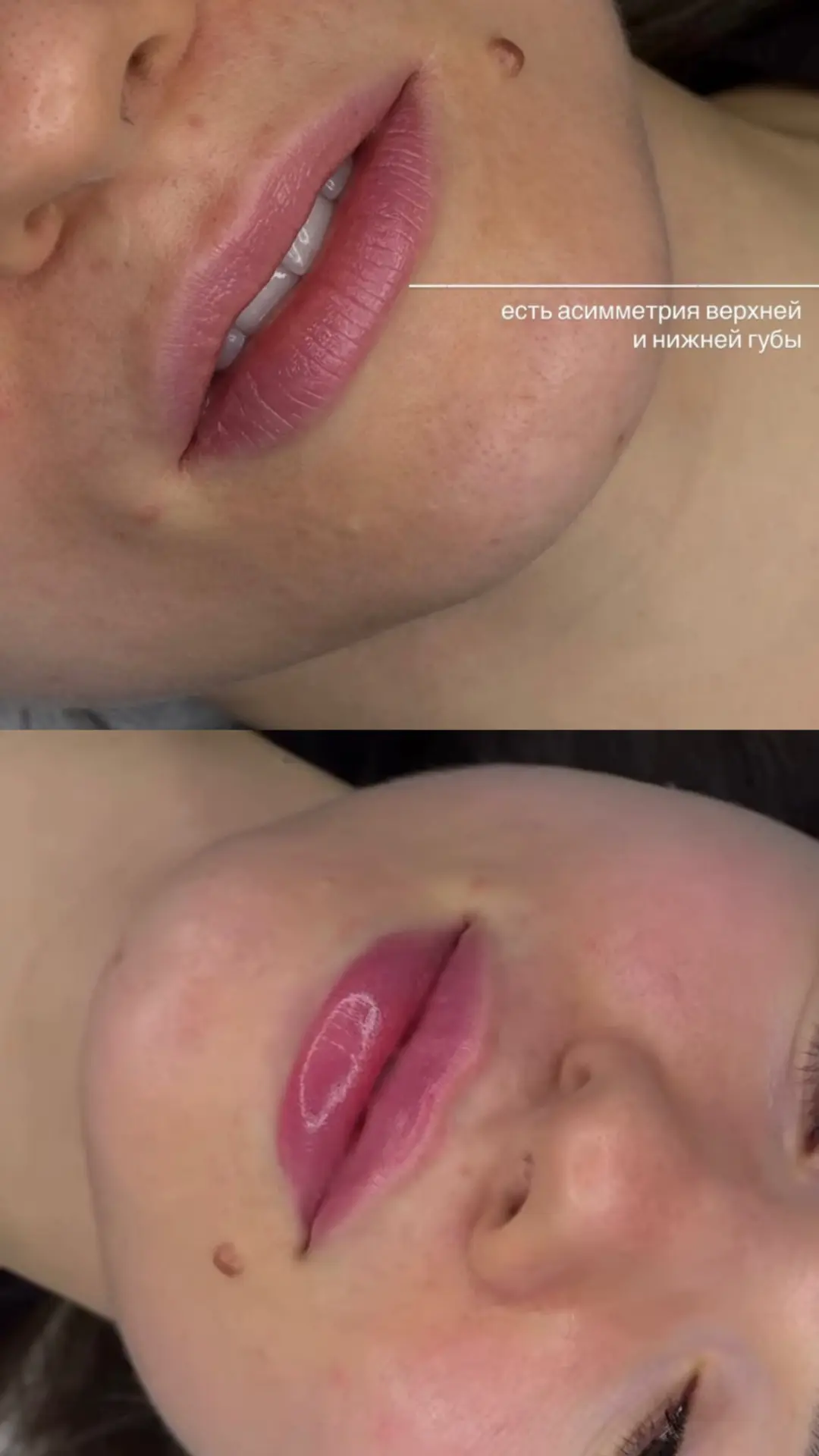 Увеличение губ💋