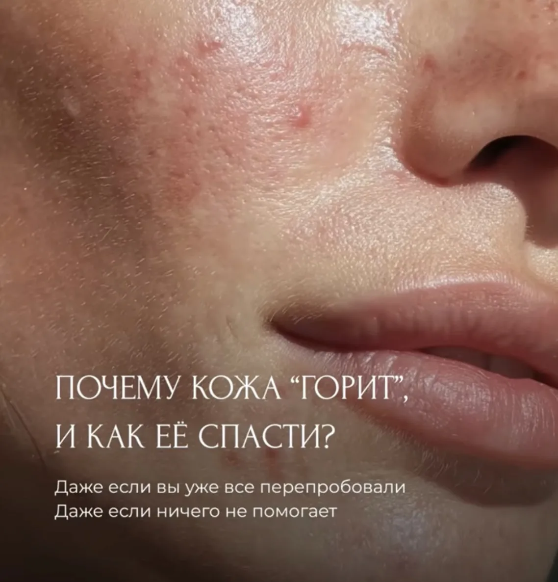 Почему кожа «горит» и как её спасти? 🩷

Жжение — это сигнал, что защитный барьер кожи повреждён или