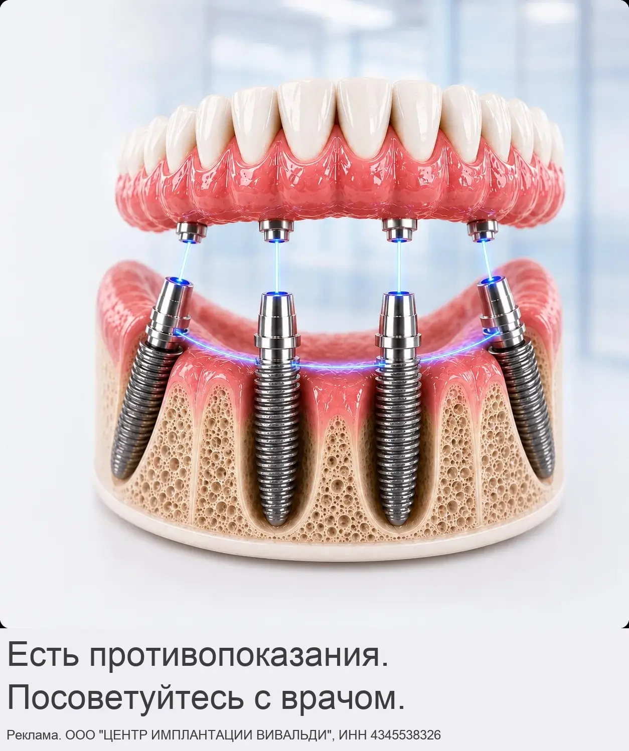 Все зубы за 1 день в центре Кирова! От 9 500 ₽ в месяц!