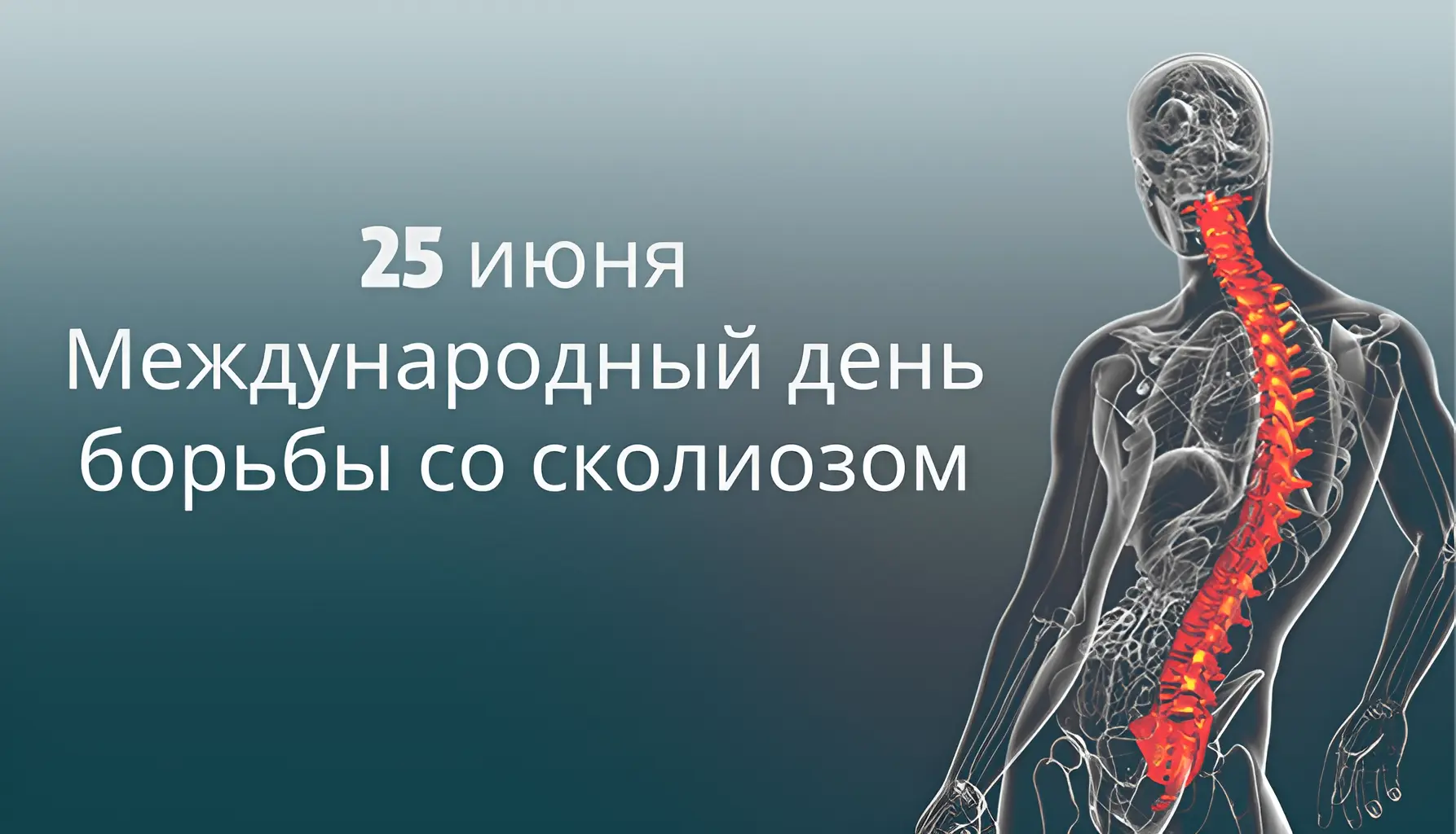 🦴 25 июня – Международный день борьбы со сколиозом