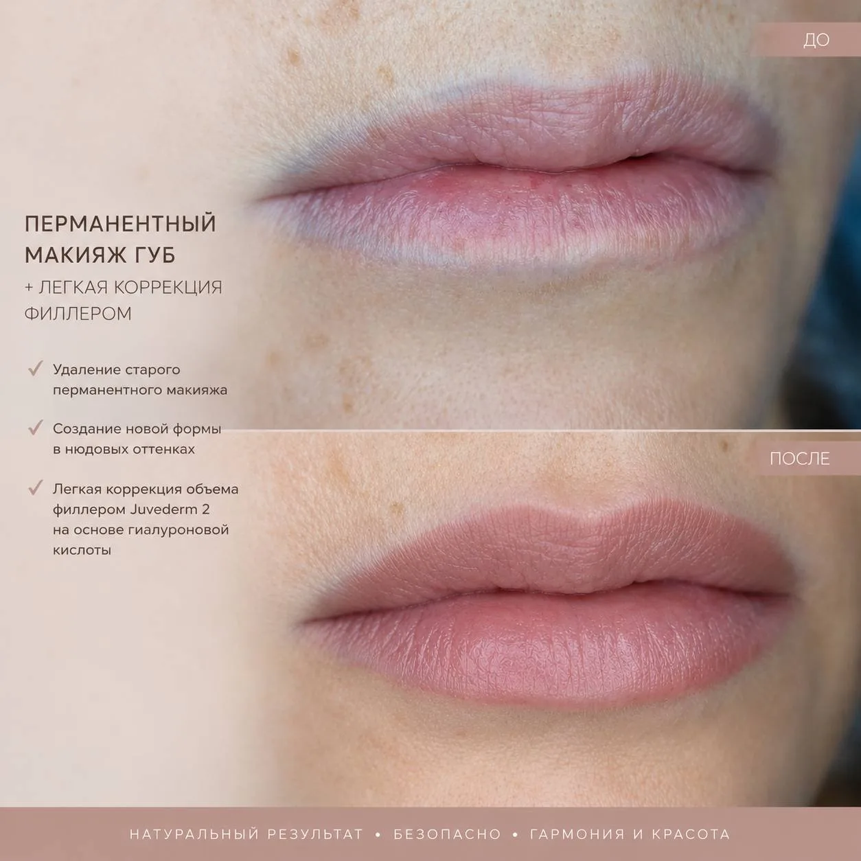 На представленных фото «до» и «после» показан результат комплексной коррекции: старый татуаж был уда