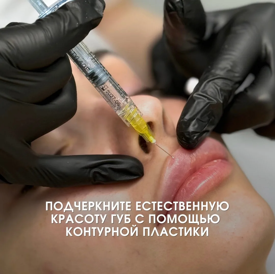 Преимущества контурной пластики губ 👄