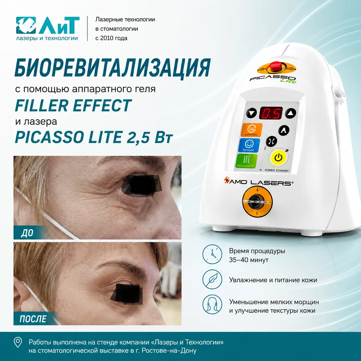 Биоревитализация с использованием геля FILLER EFFECT и лазера PICASSO LITE 2,5 Вт

На фотографии пре