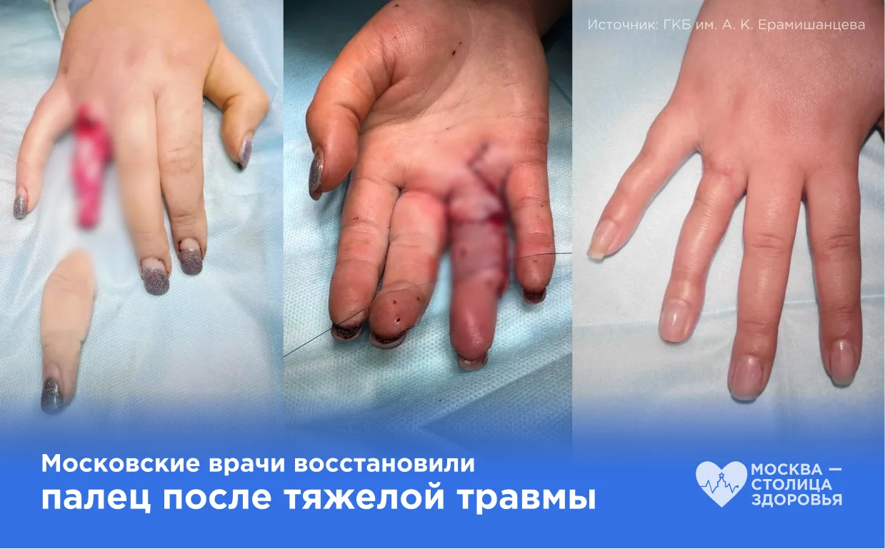 ❗ Осторожно, шокирующий контент!

В Центр микрохирургии кисти ГКБ им. А. К. Ерамишанцева поступила м