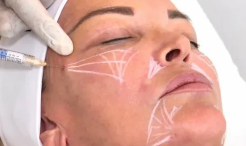 🔥Радиесс - препарат на основе гидроксилапатита кальция (ГАК), предназначен для пластич...