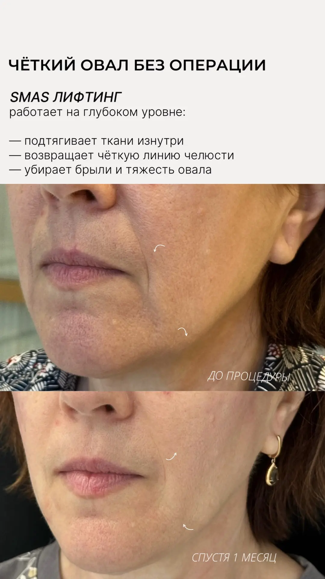 Чёткий овал без операции - за один SMAS-лифтинг ⚡️