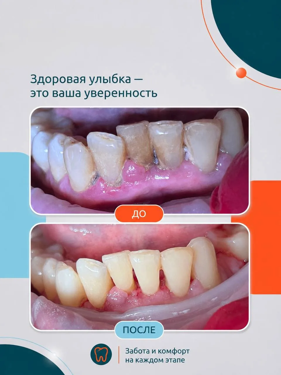 Регулярное посещение стоматолога для профессиональной гигиены рекомендуется с периодичн...
