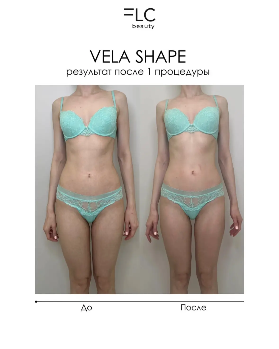Vela Shape только для похудения — миф ❌

Многие думают, что Vela Shape — процедура исключительно для